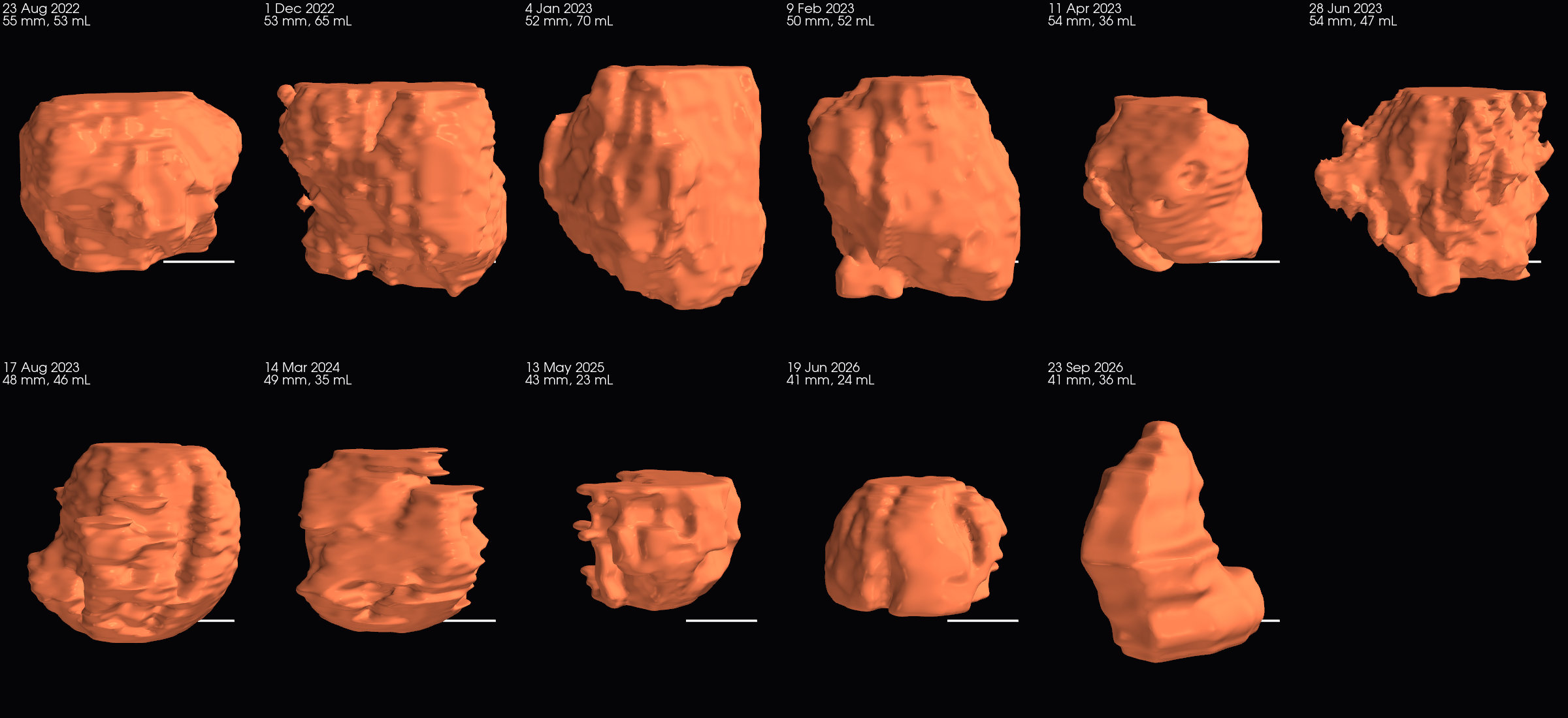3D shape of the gastric-wall mass on the ten dates