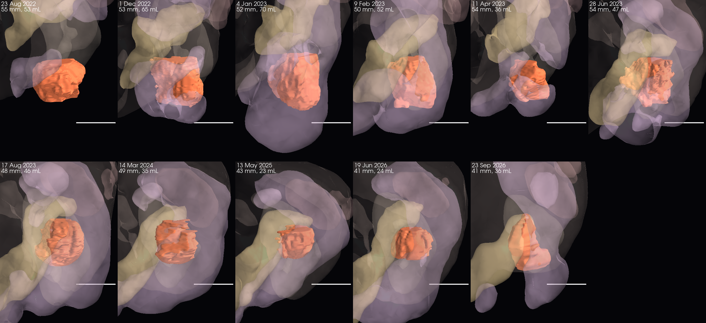 Gastric-wall mass with ghost organs