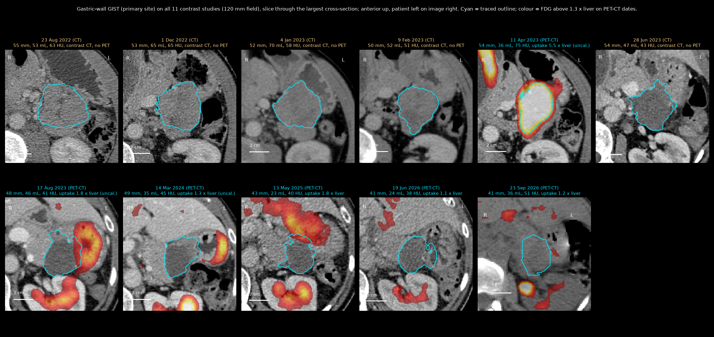 Gastric-wall GIST on all ten studies
