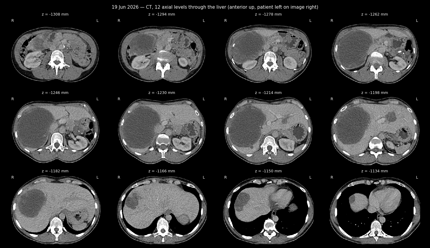 CT sheet
