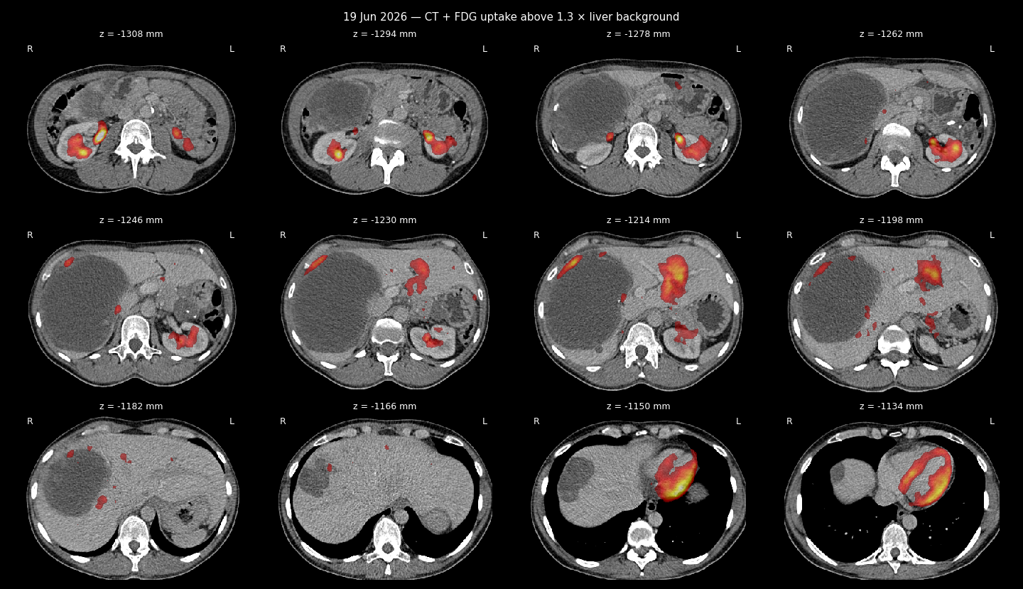 PET/CT sheet