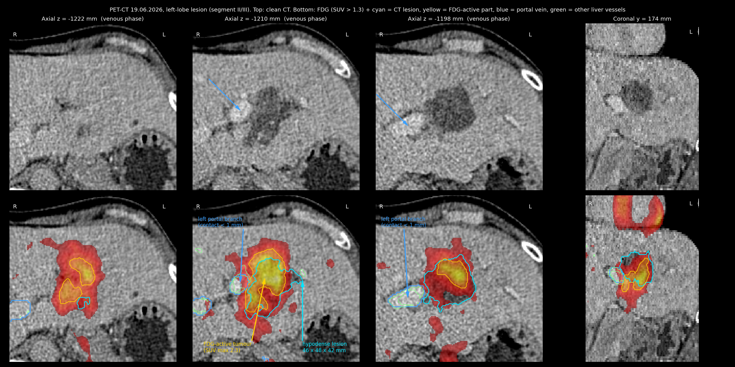Annotated axial and coronal slices