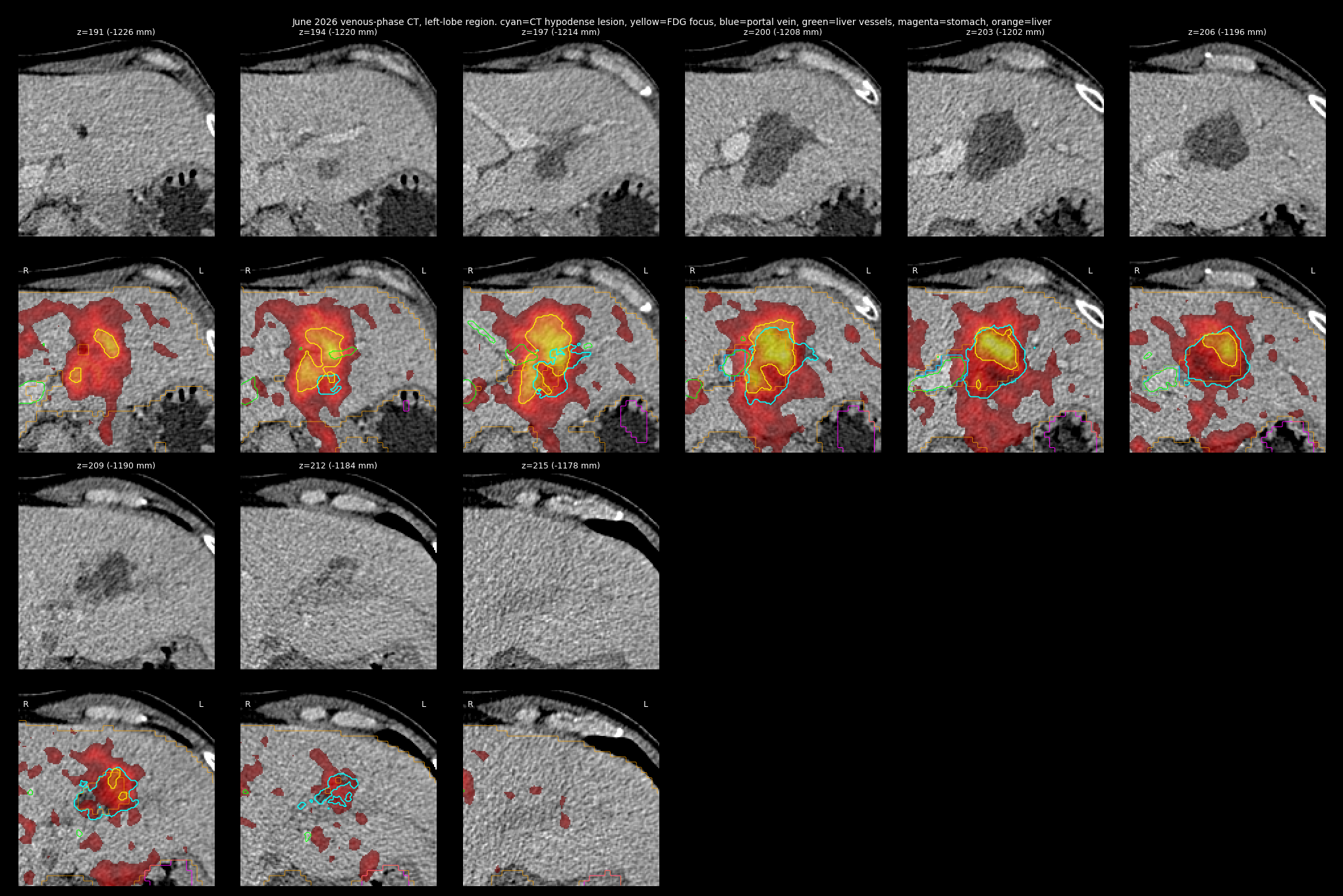 Nine axial slices through the lesion