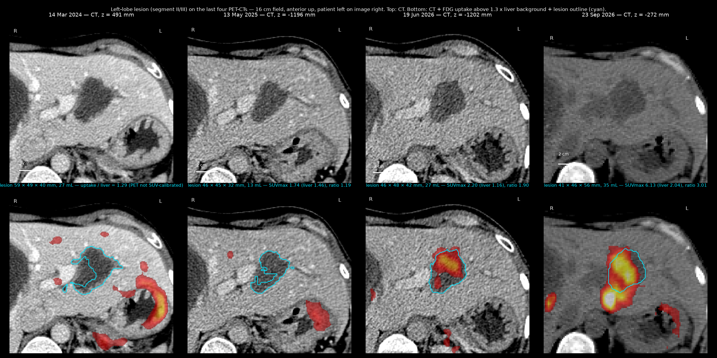 Left-lobe lesion on the 2024, 2025 and two 2026 PET-CTs