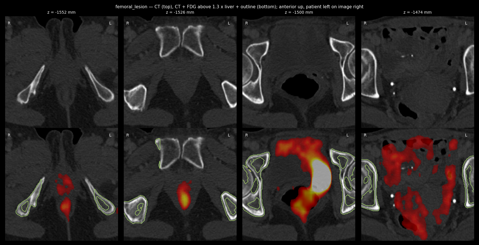 femoral heads