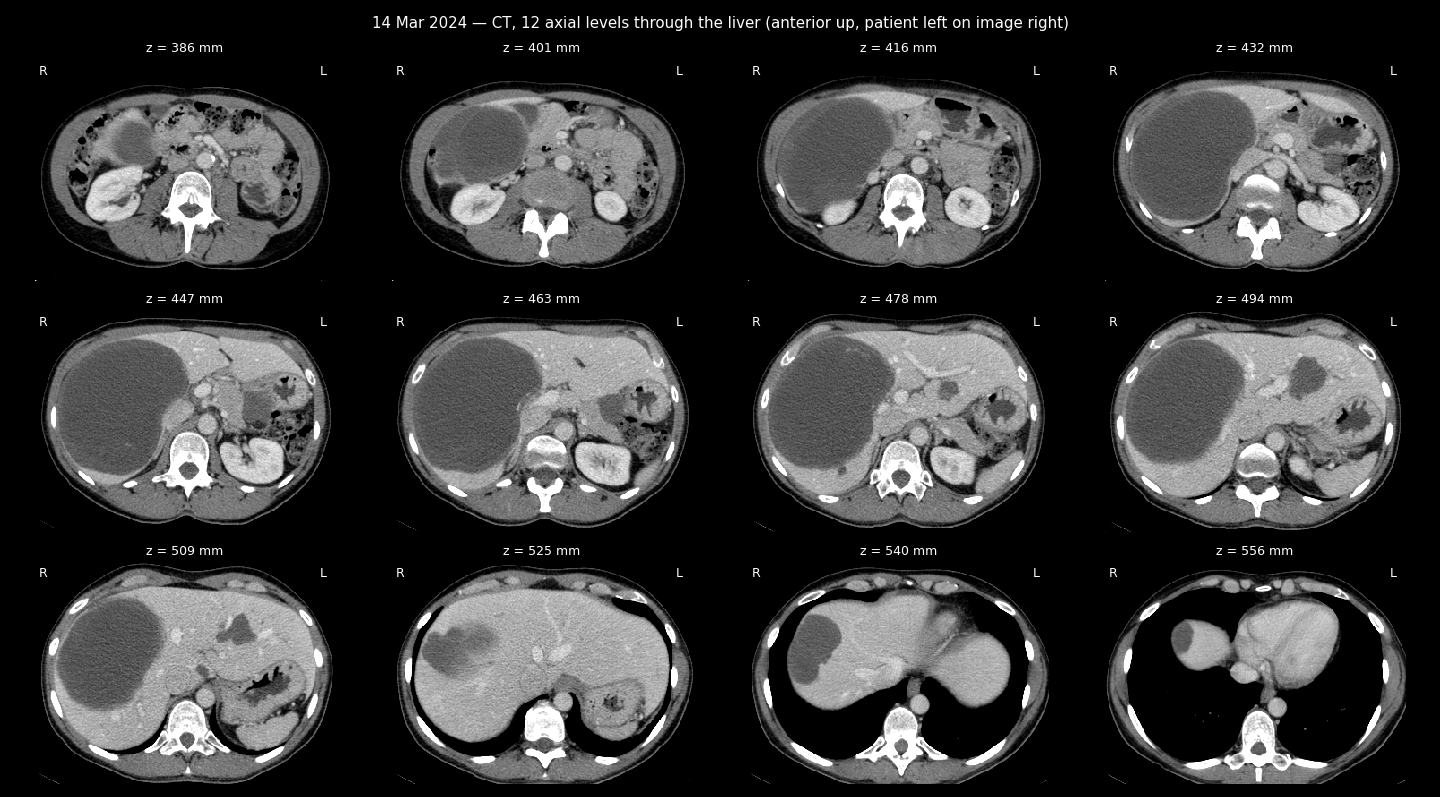 CT sheet