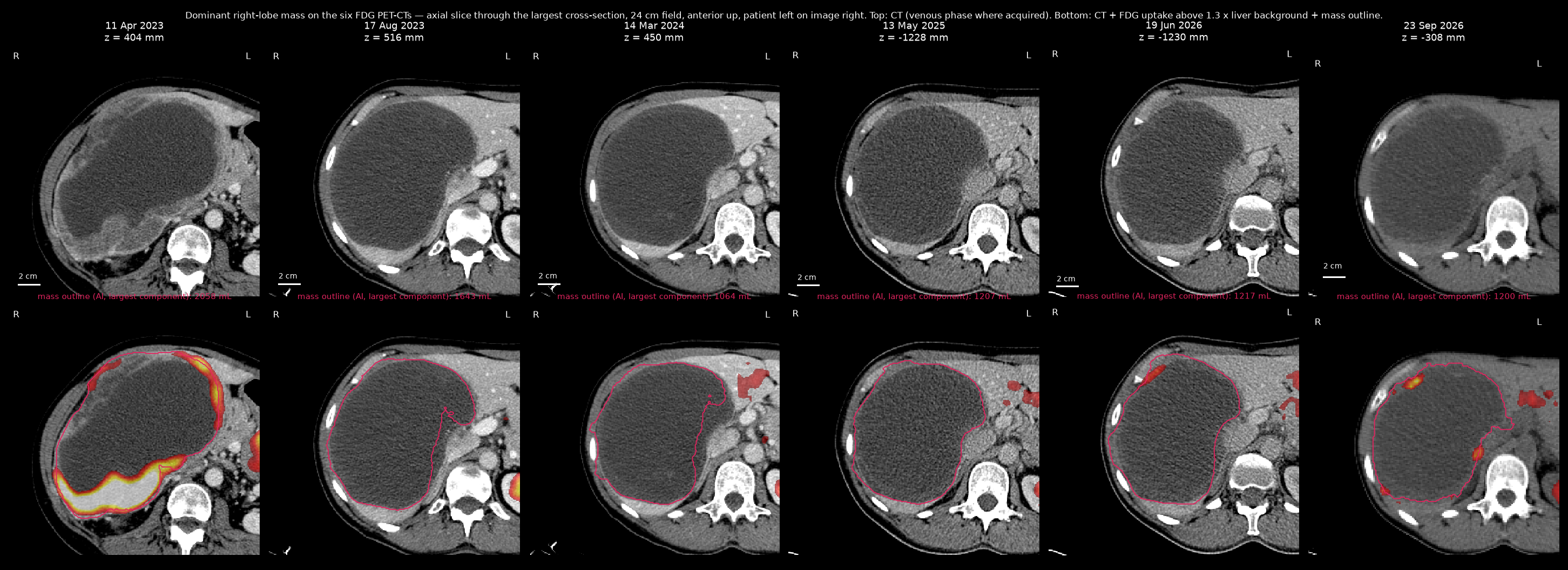 Dominant right-lobe mass on all six PET-CTs