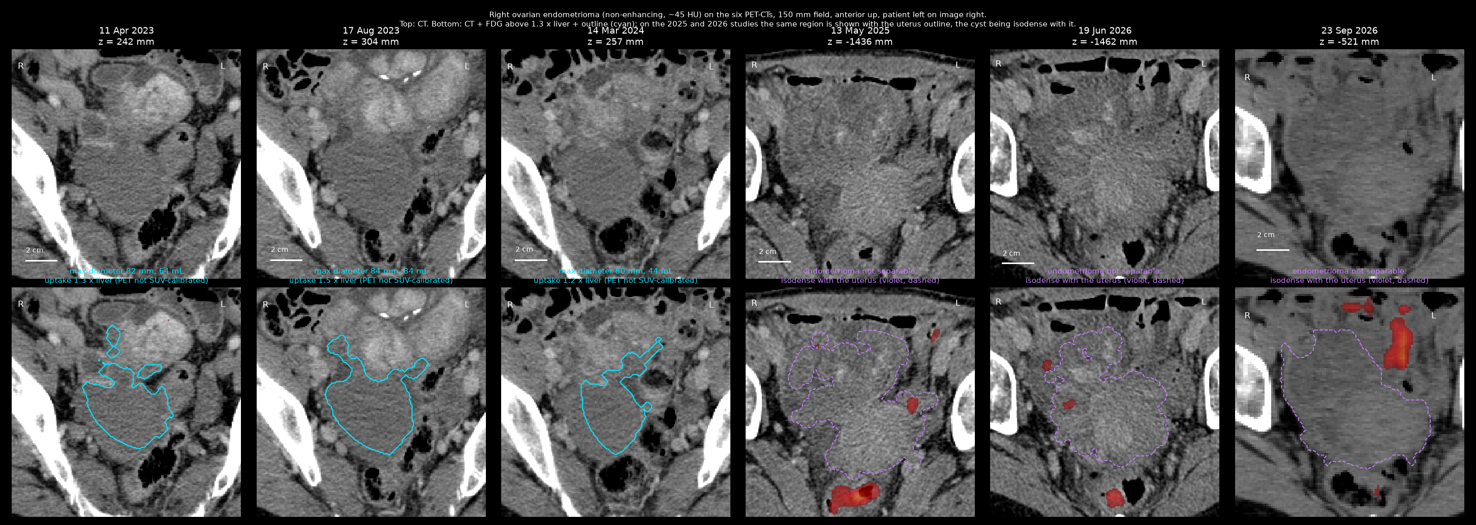 Right ovarian endometrioma on the PET-CTs