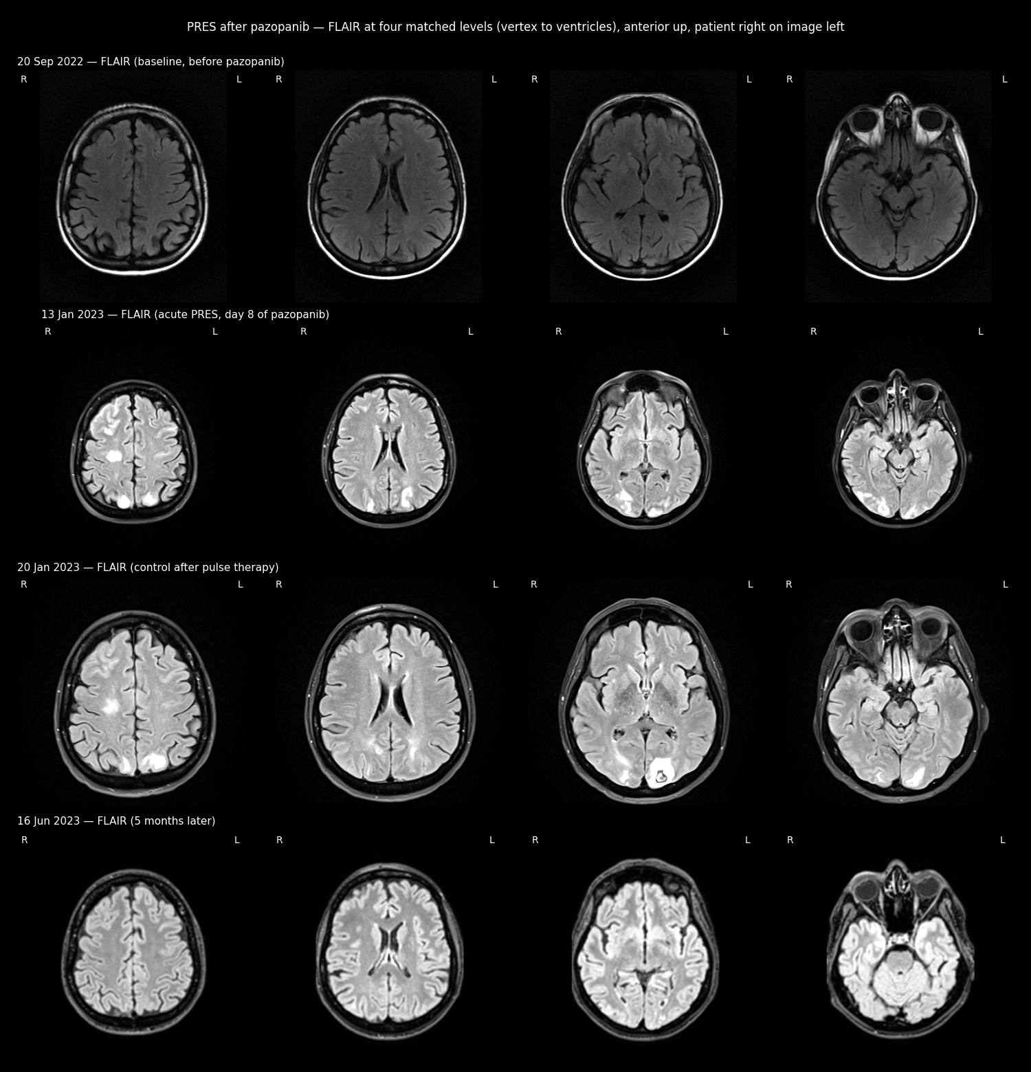 FLAIR brain MRI at four dates