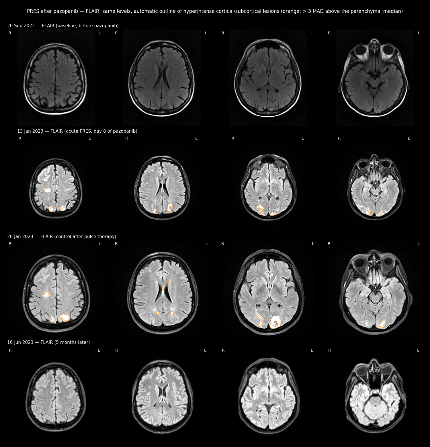 FLAIR with automatic lesion outlines