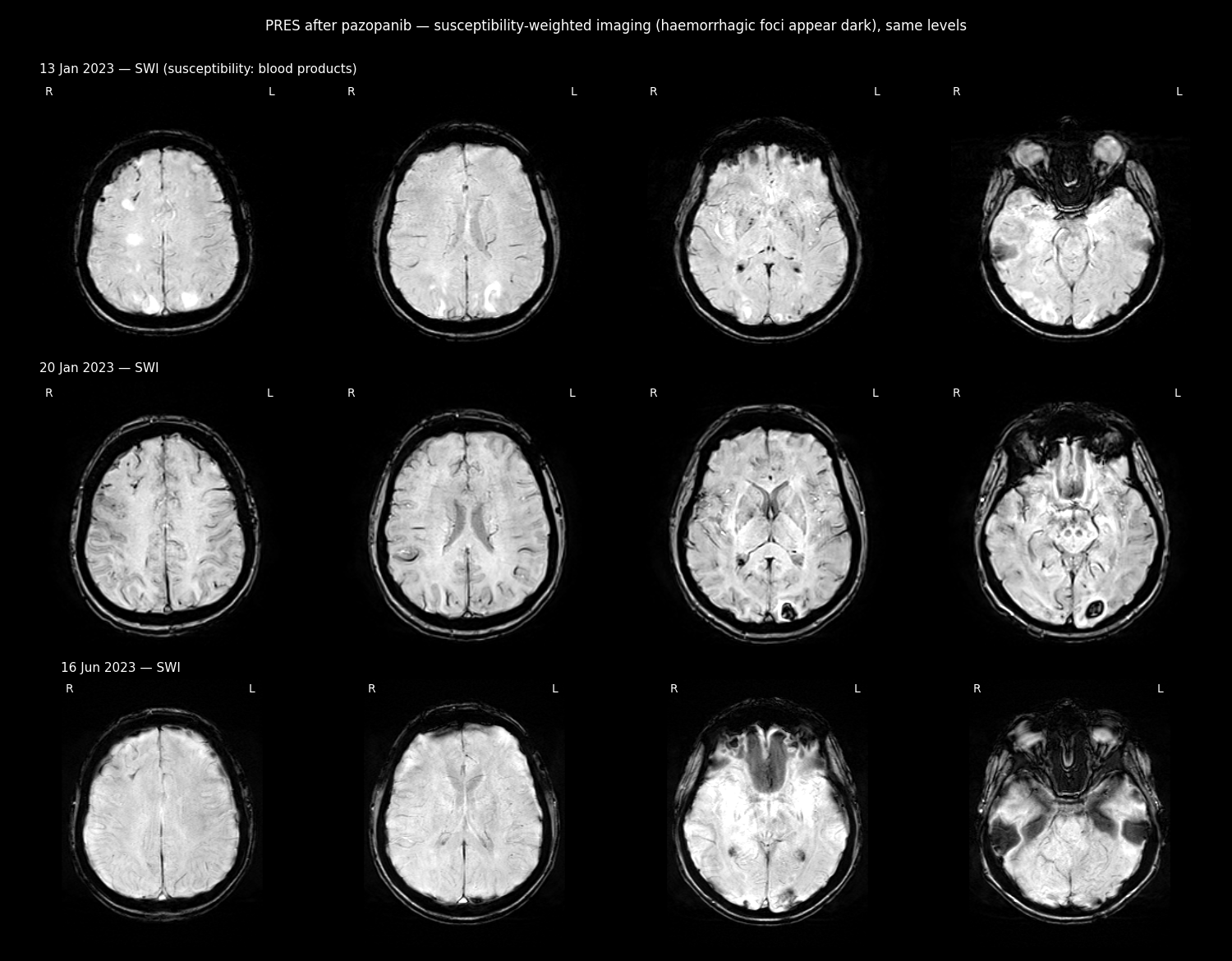 SWI brain MRI at three dates