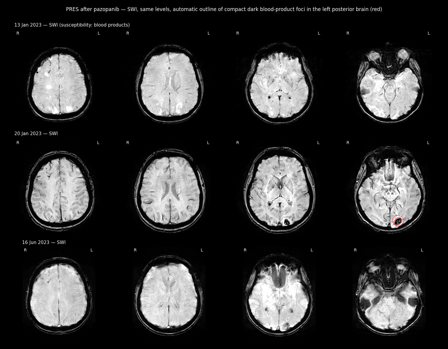 SWI with haemorrhage marks