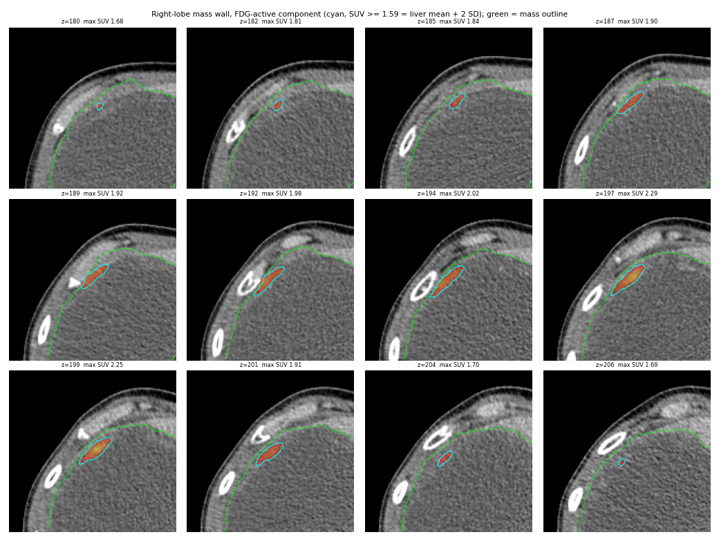 Active wall of the right-lobe mass