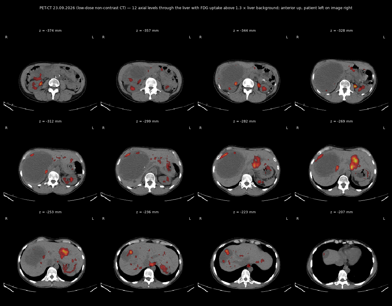 PET/CT sheet