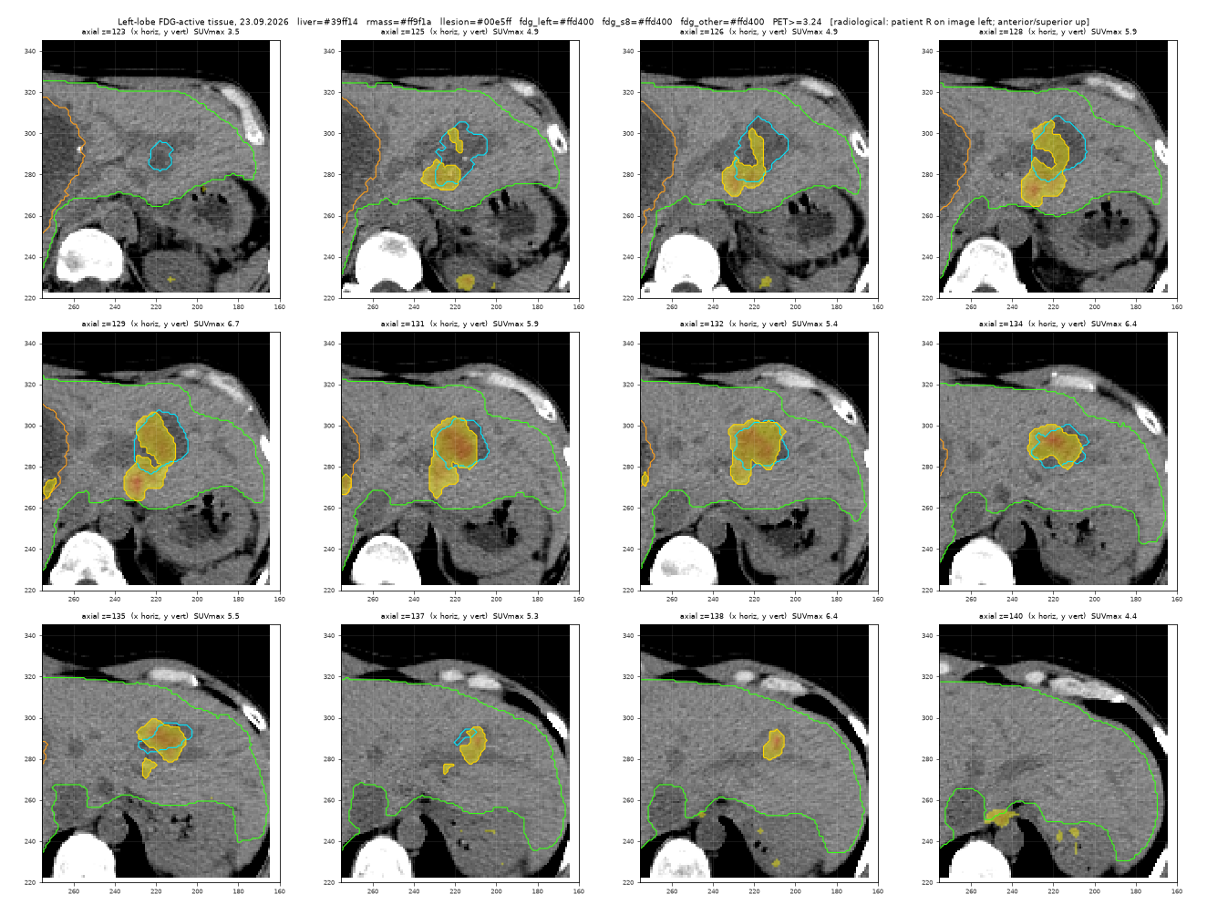 Left-lobe FDG-active tissue, axial slices