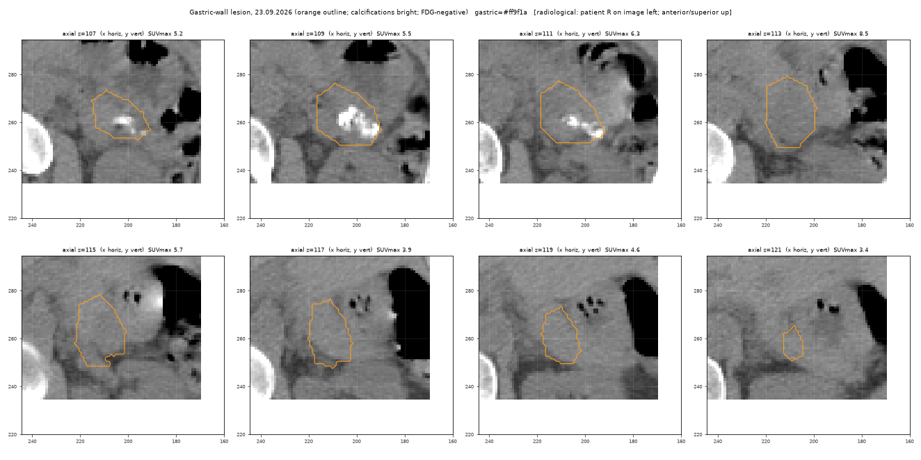 Gastric lesion slices