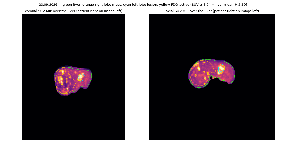 PET maximum-intensity projection