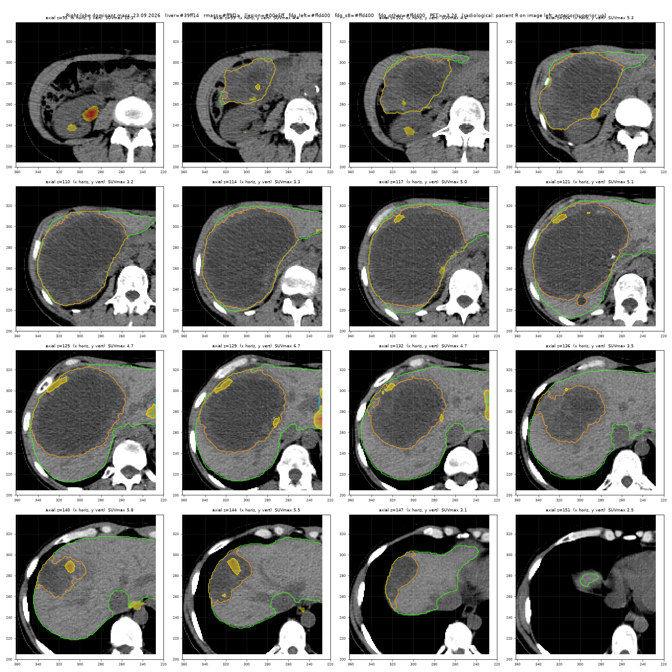 Right-lobe mass slices