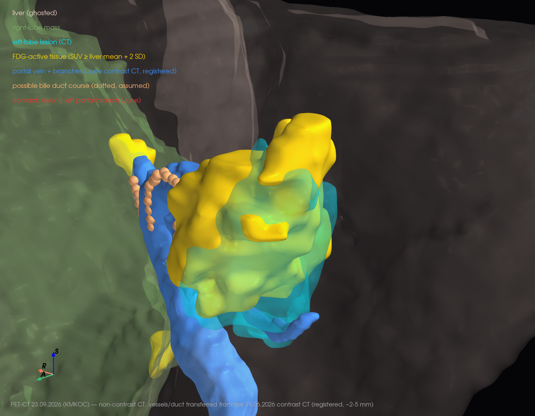 3D close-up of the left-lobe lesion