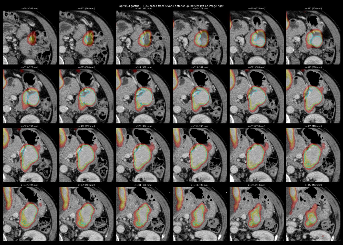 gastric trace apr2023