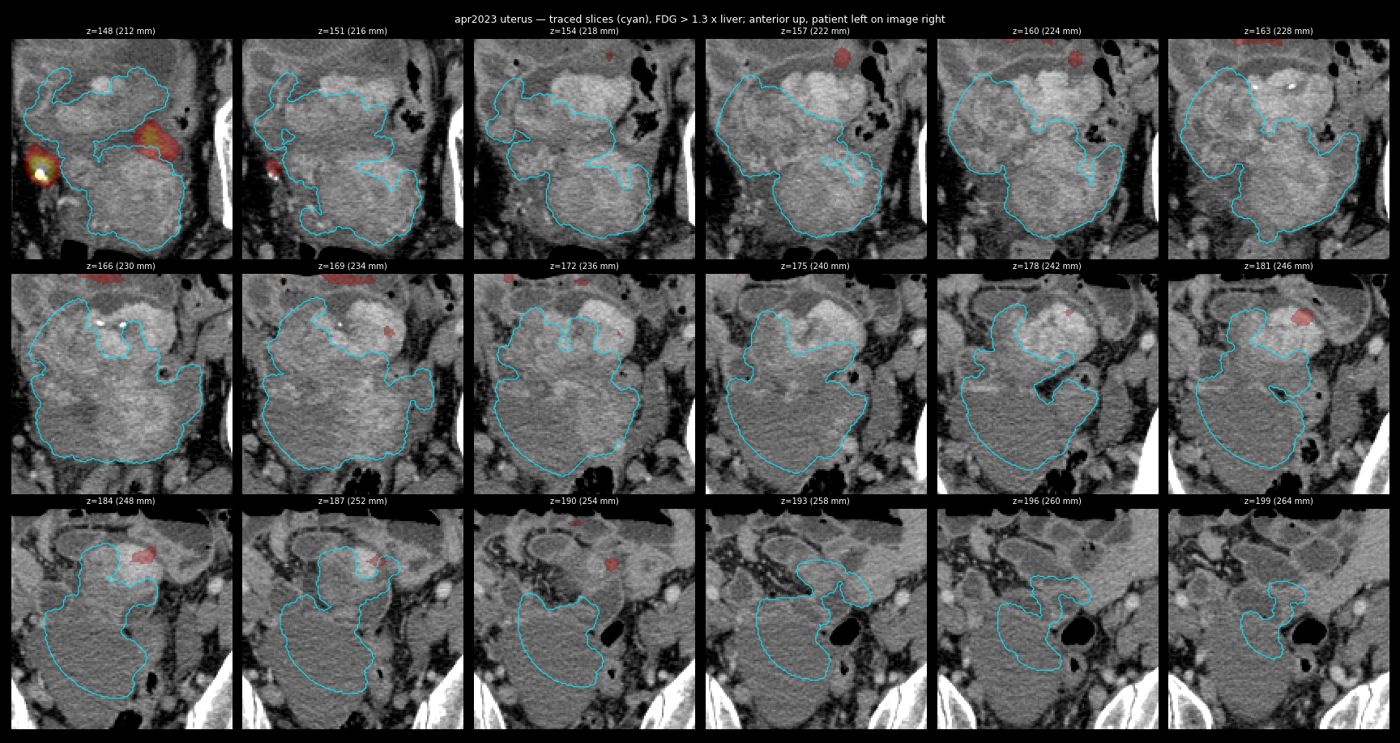 uterus trace apr2023