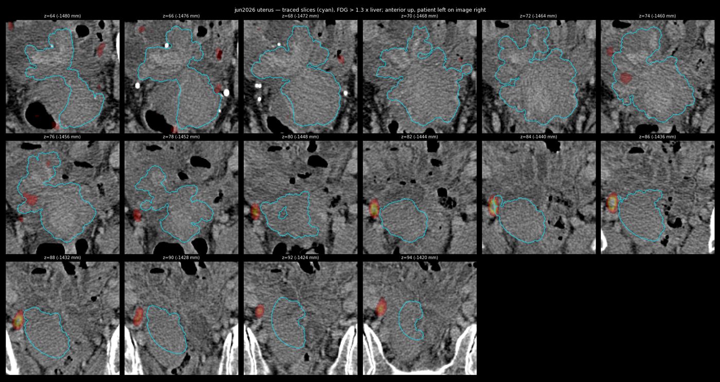 uterus trace jun2026