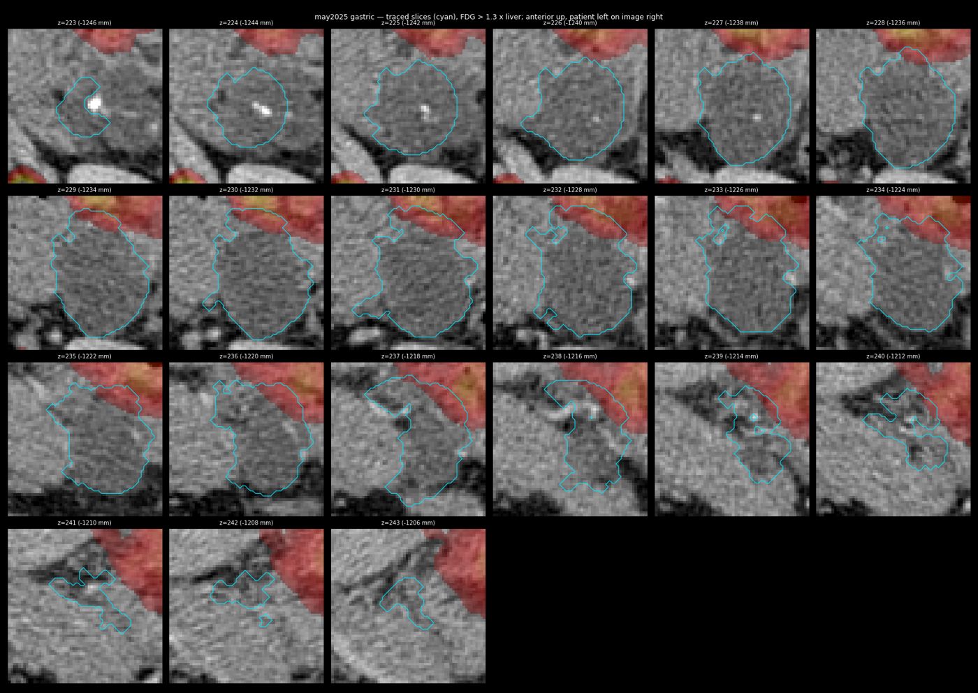 gastric trace may2025