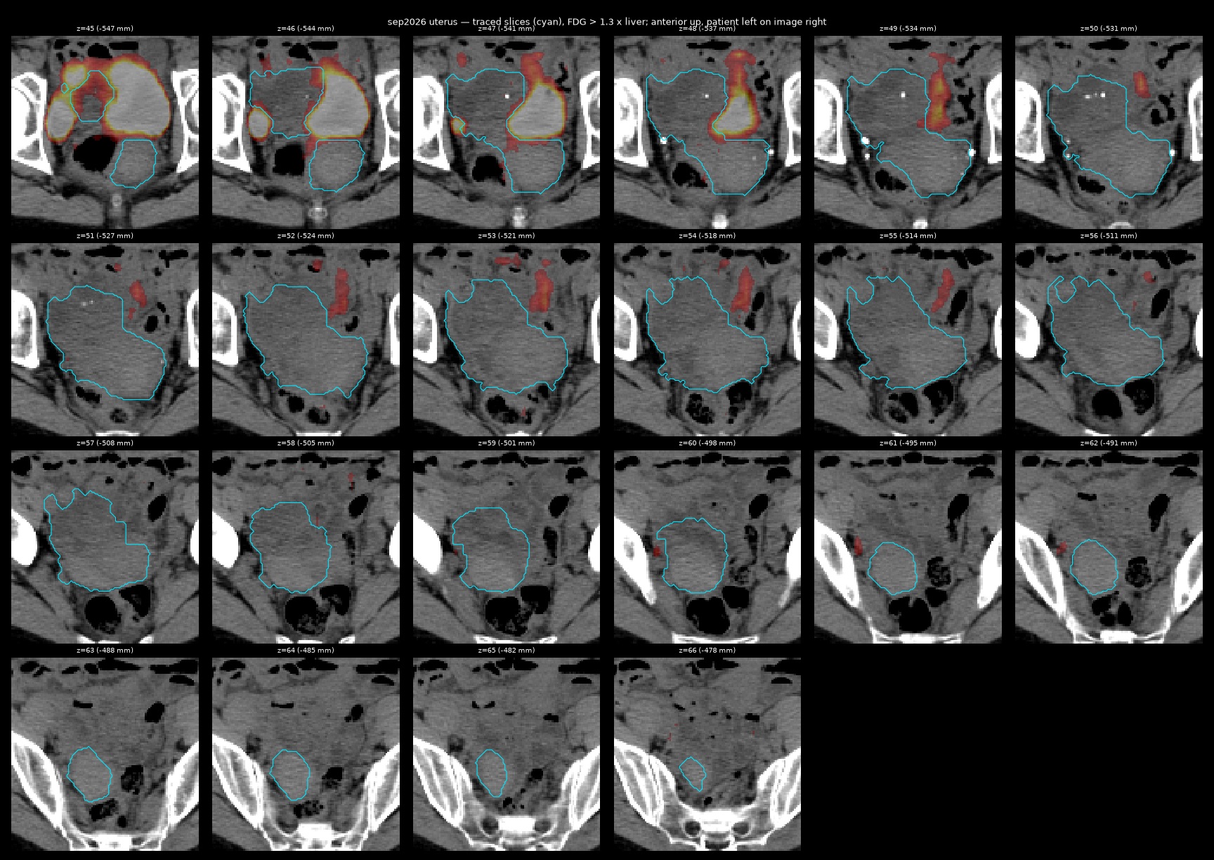 uterus trace sep2026