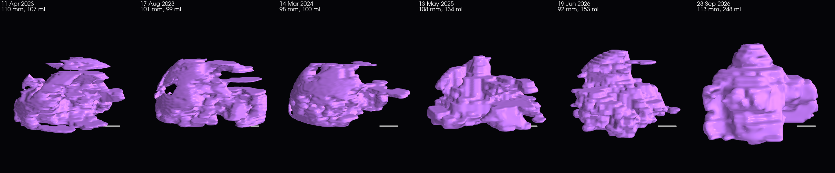 3D shape of the uterus on the five dates