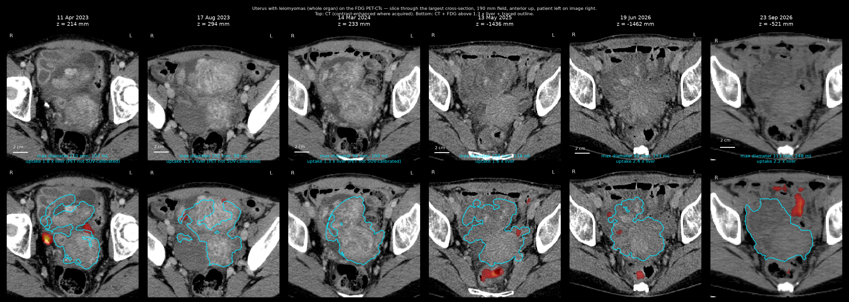 Uterus with fibroids on the five PET-CTs