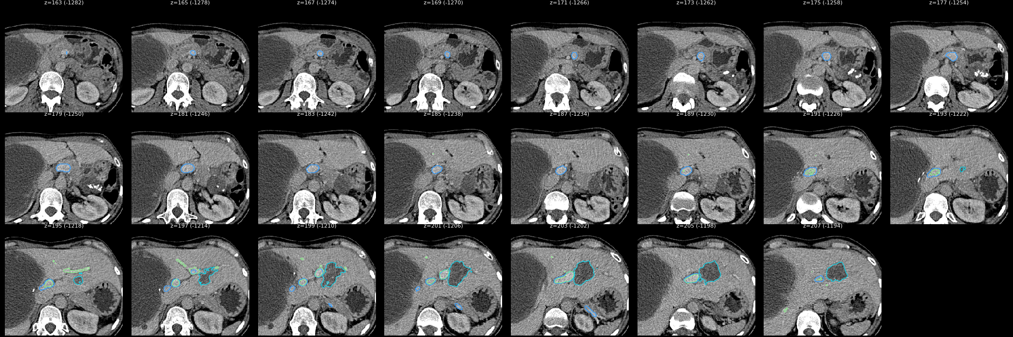 portal vein slices