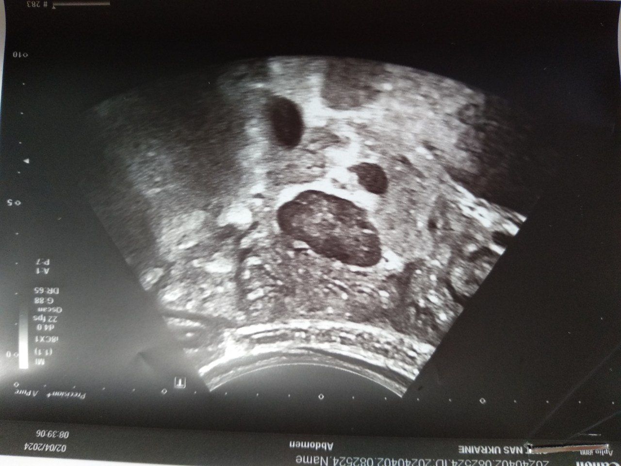 UKR_orig/Ultrasound diagnostic results 02.04.2024/photo1.jpg