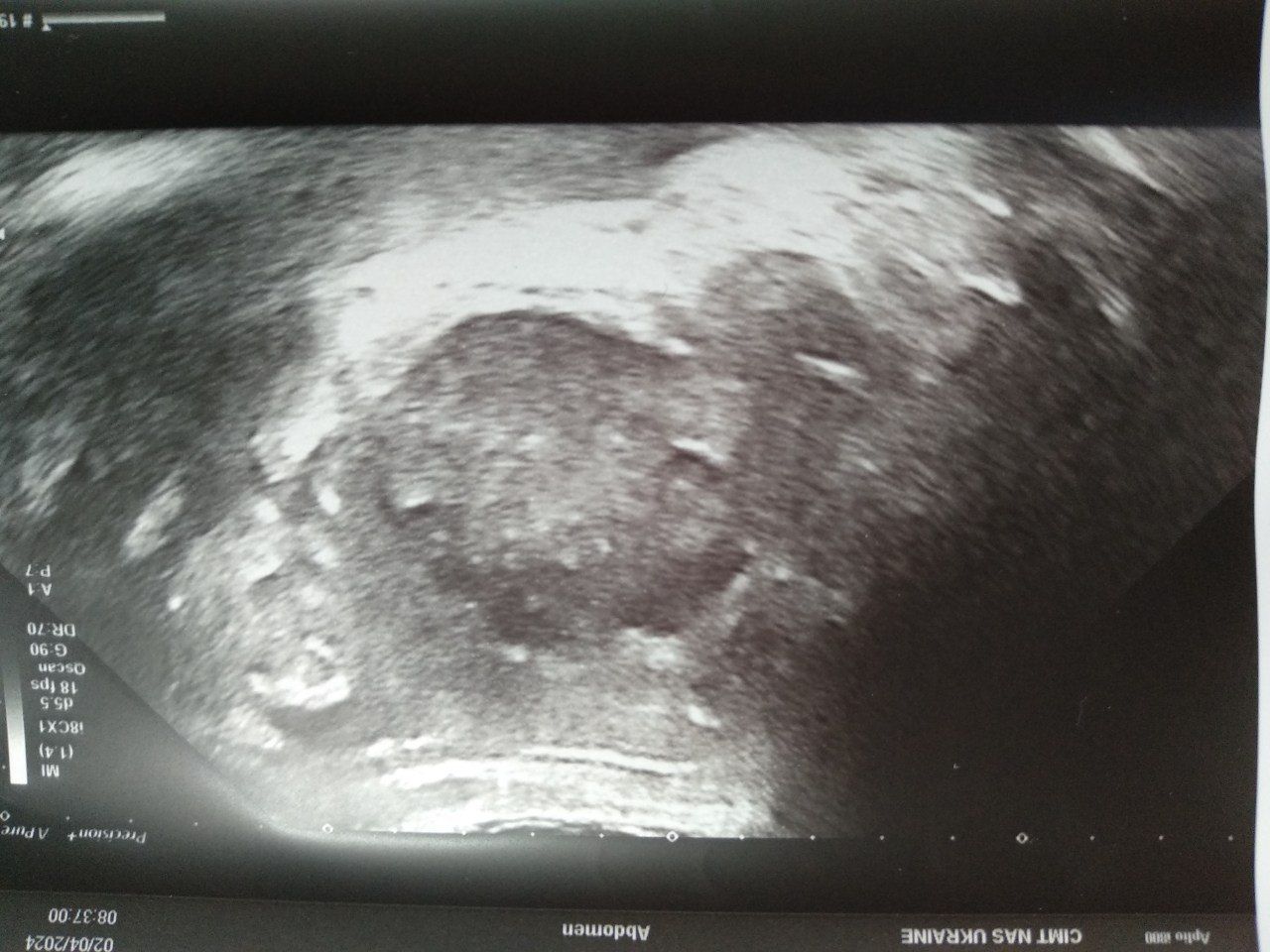 UKR_orig/Ultrasound diagnostic results 02.04.2024/photo2.jpg