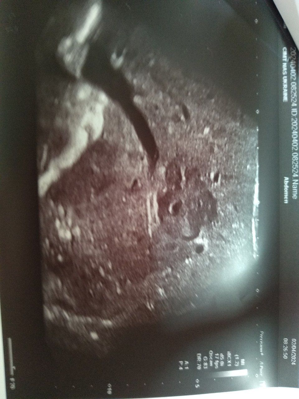 UKR_orig/Ultrasound diagnostic results 02.04.2024/photo3.jpg