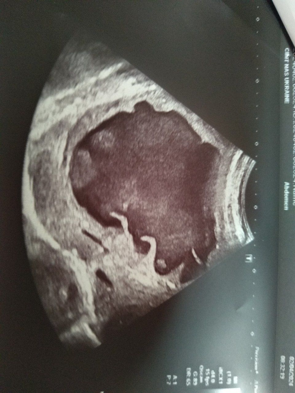 UKR_orig/Ultrasound diagnostic results 02.04.2024/photo4.jpg